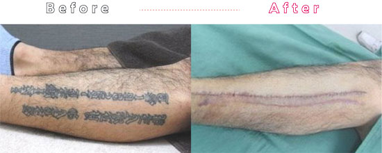 タトゥー・刺青切除法の症例写真02
