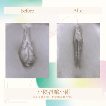 小陰唇縮小術02