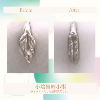 小陰唇縮小術03