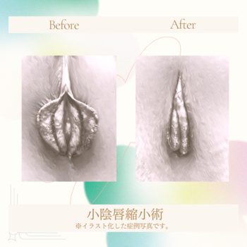 小陰唇縮小術04