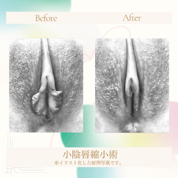 小陰唇縮小術05