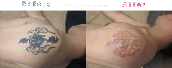 タトゥー・刺青レーザー除去法の症例写真01