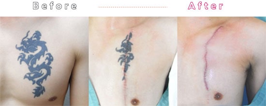 タトゥー・刺青切除法の症例写真03